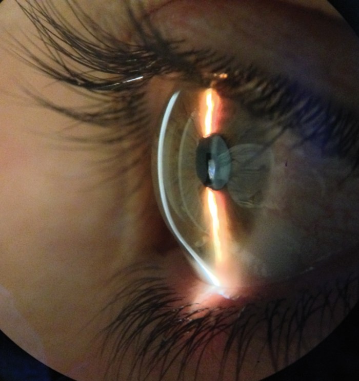 Degeneración marginal pelúcida