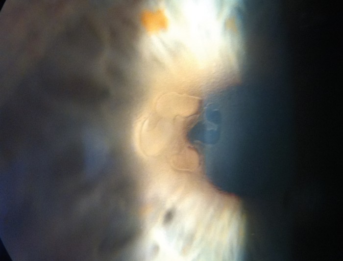 Distrofia corneal de la membrana basal