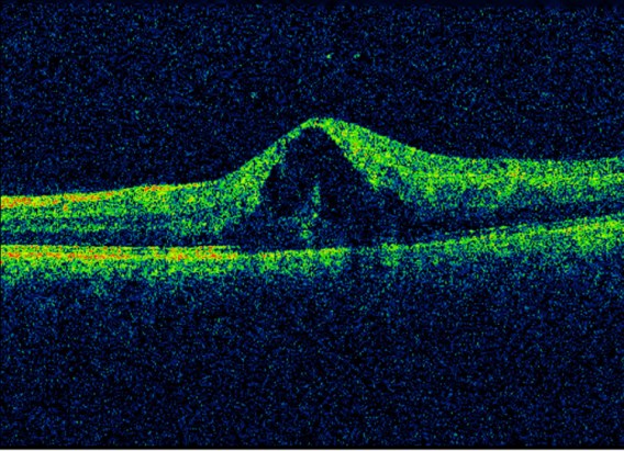 Tomografia macular