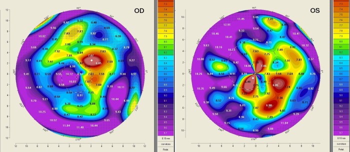 Figura 3 - Topografia Corneal Irregular del paciente